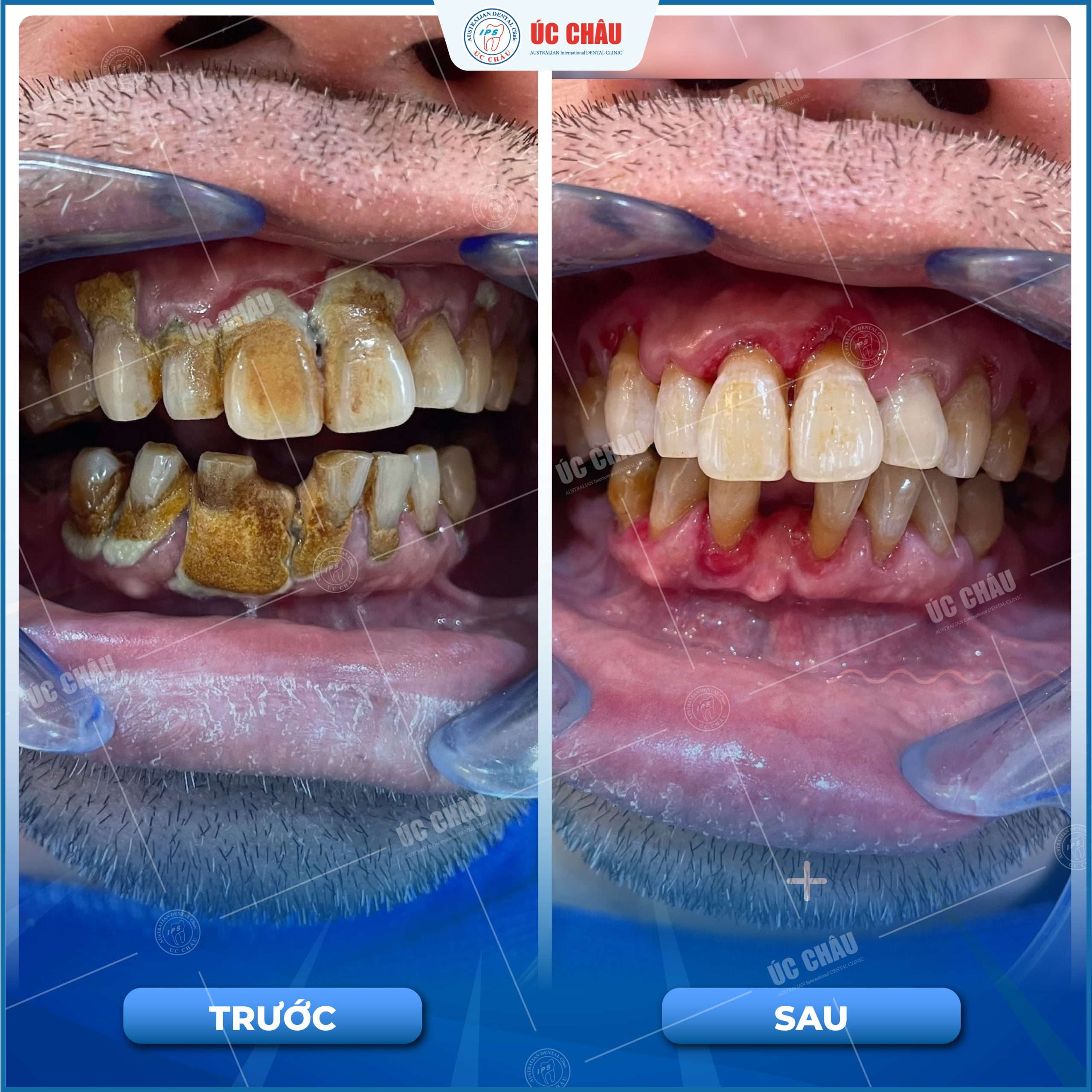 lay-cao-rang-lau-nam