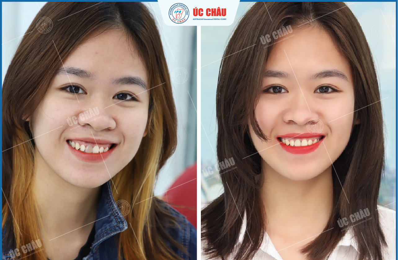 boc-rang-su-uy-tin-o-da-nang