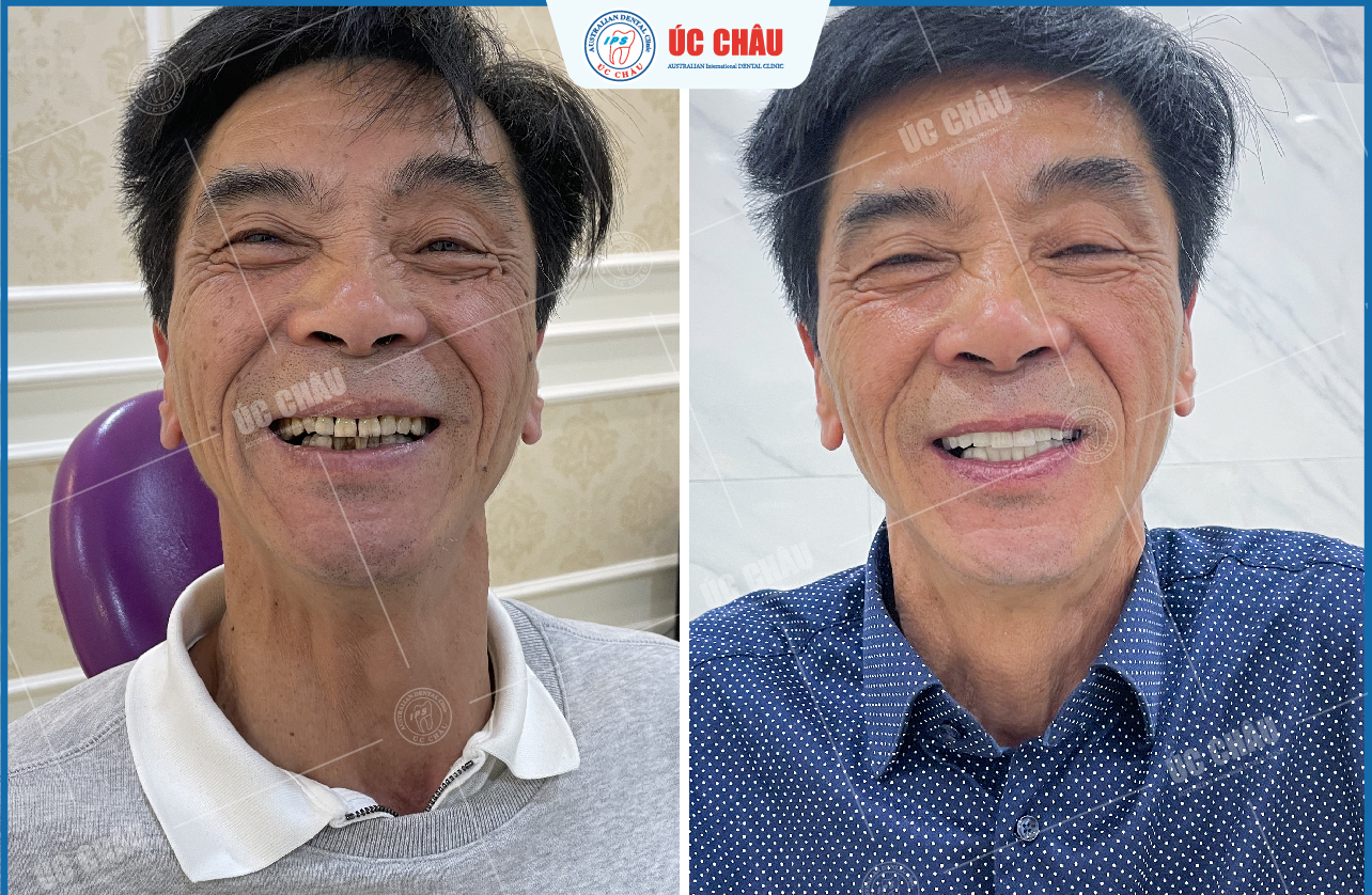 boc-rang-su-tai-da-nang