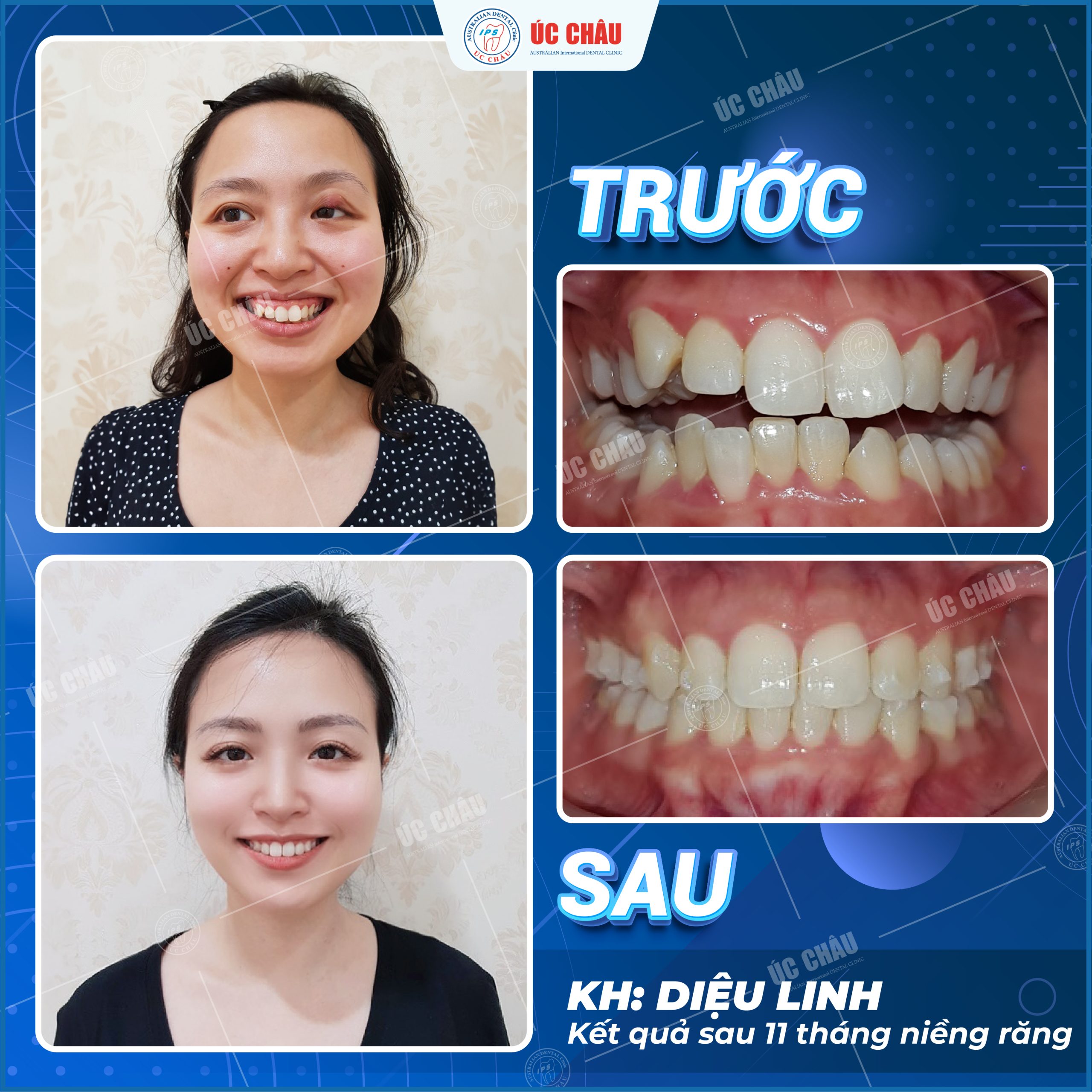 nieng-rang-truoc-sau