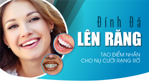 Đính đá lên răng – Tạo điểm nhấn cho nụ cười rạng rỡ