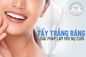 Tẩy trắng răng – Răng trắng bật tone, nụ cười rạng rỡ