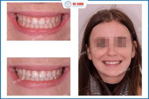 CHỮA CƯỜI HỞ LỢI KHÔNG TÁI PHÁT – GIẢI PHÁP SỞ HỮU NỤ CƯỜI ĐẸP HOÀN HẢO