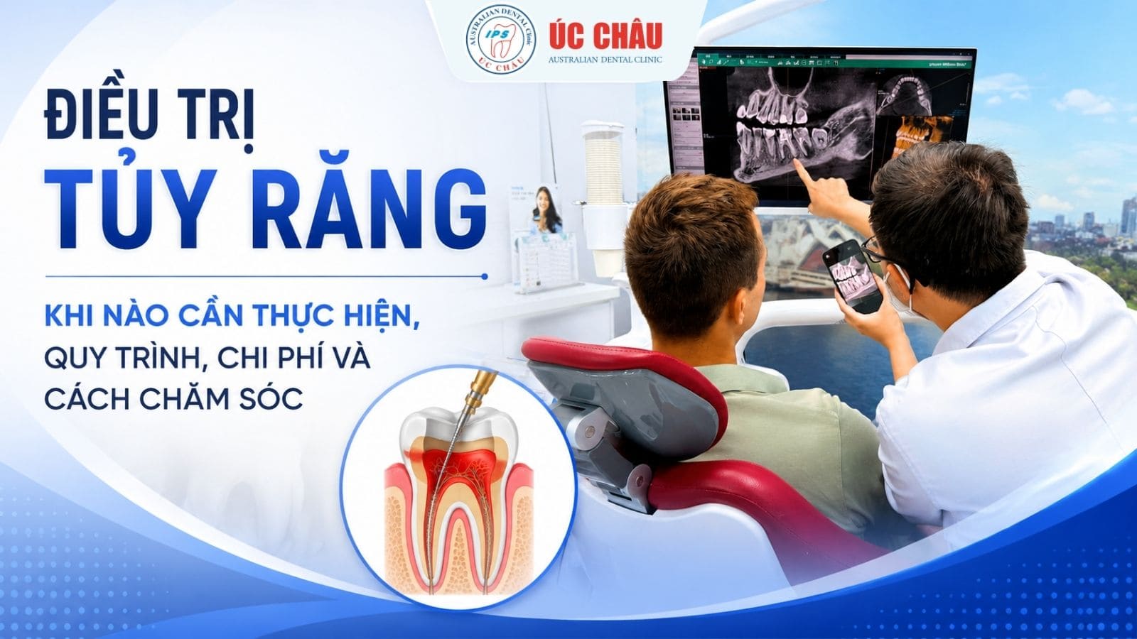 Điều Trị Tủy Răng: Khi Nào Cần Thực Hiện, Quy Trình, Chi Phí Và Cách Chăm Sóc 1 dieu-tri-tuy-rang