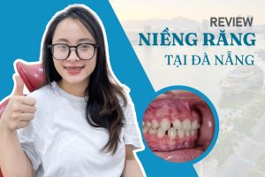 Review Niềng răng tại Đà Nẵng – Chia sẻ kinh nghiệm của khách hàng