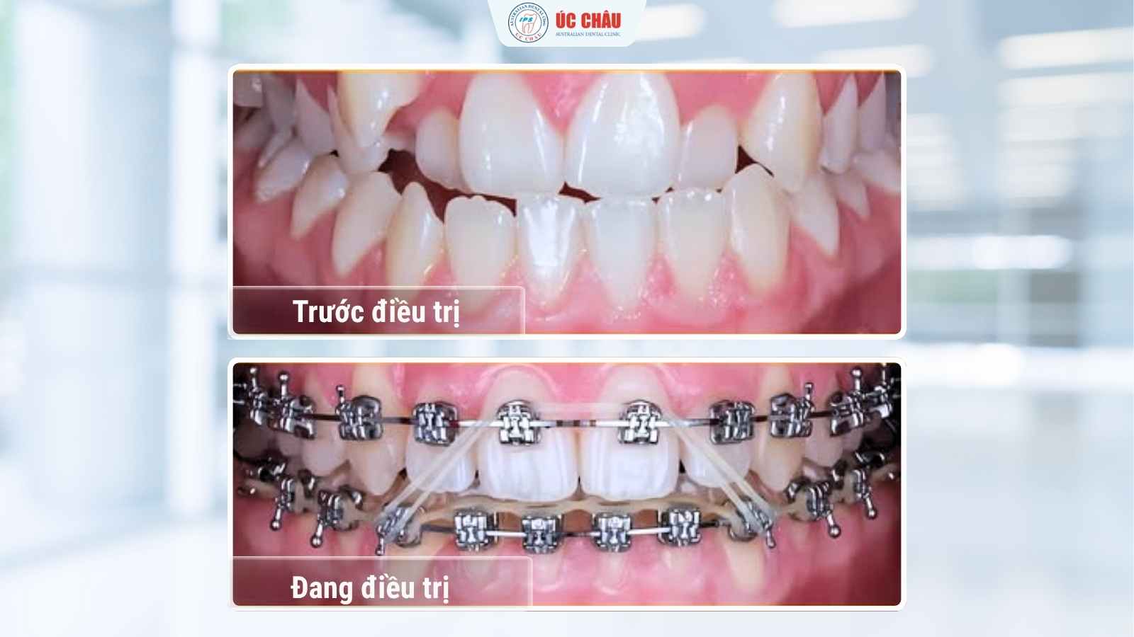 Nieng-rang-moc-lech-tai-nha-khoa-uc-chau