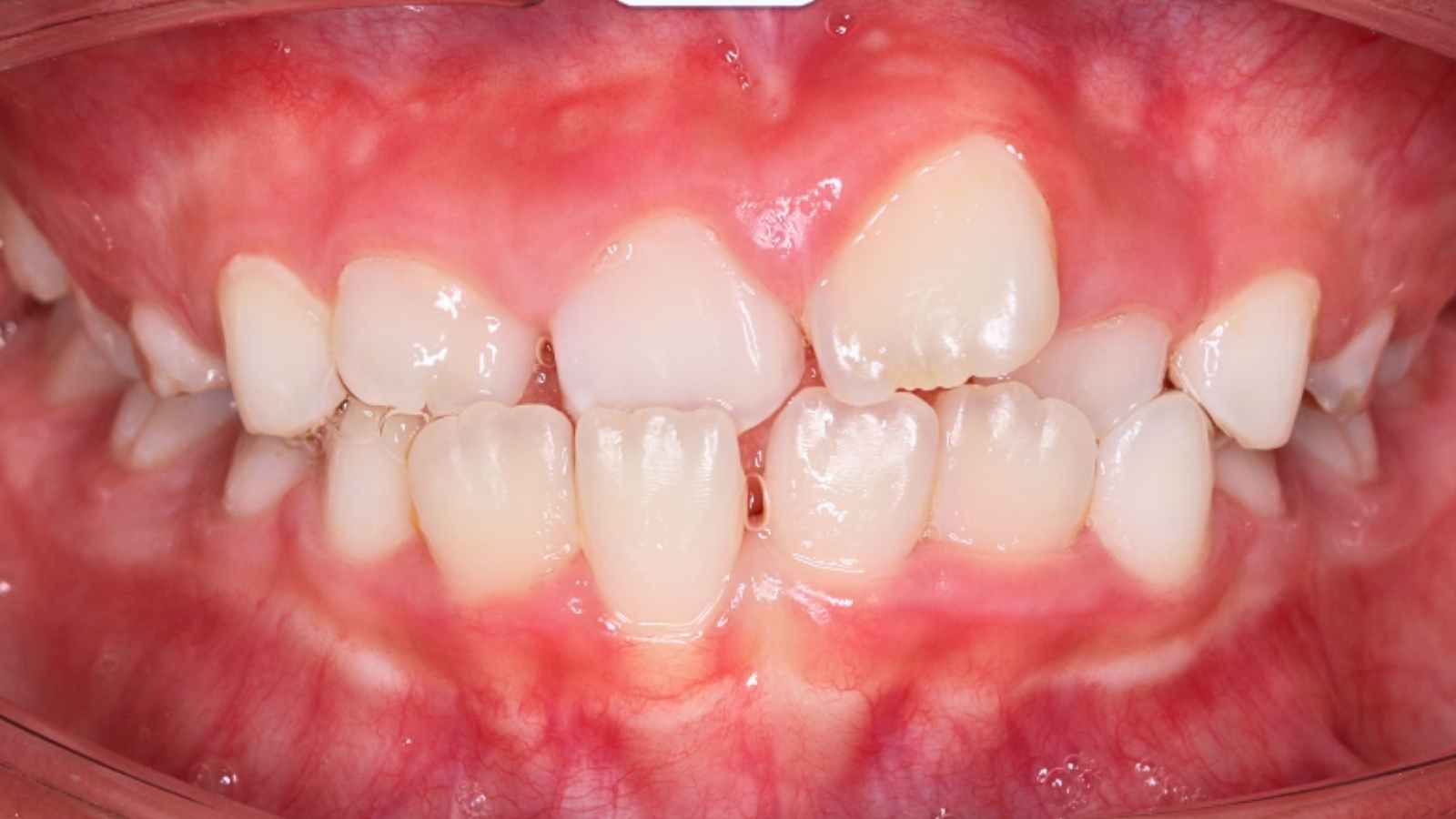 rang-moc-lech-cung-ham